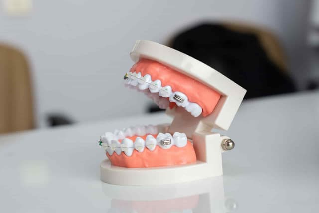 Bagues orthodontiques — traitement orthodontique Agen